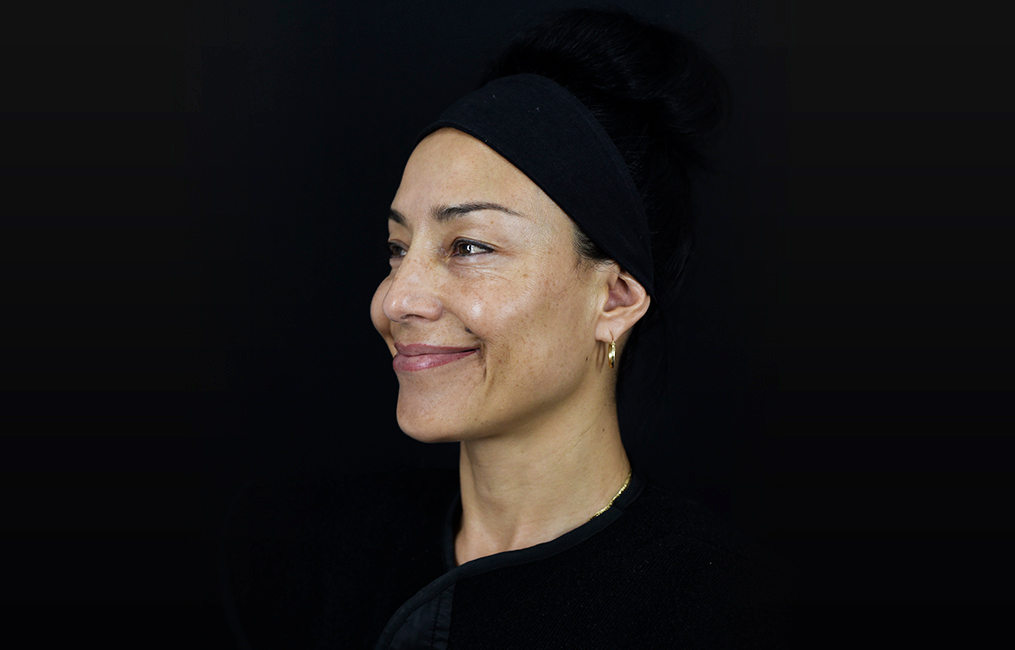 Tratamiento juvederm