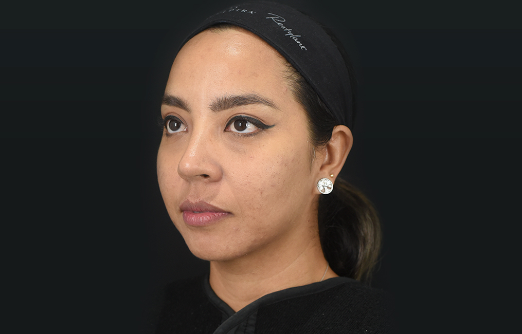 Tratamiento aumento de labios