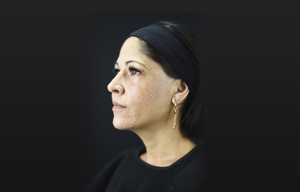 Tratamiento láser CO2