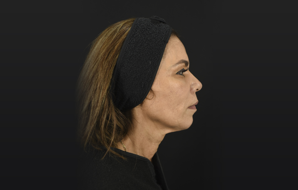 Dermal Fillers by Oneline