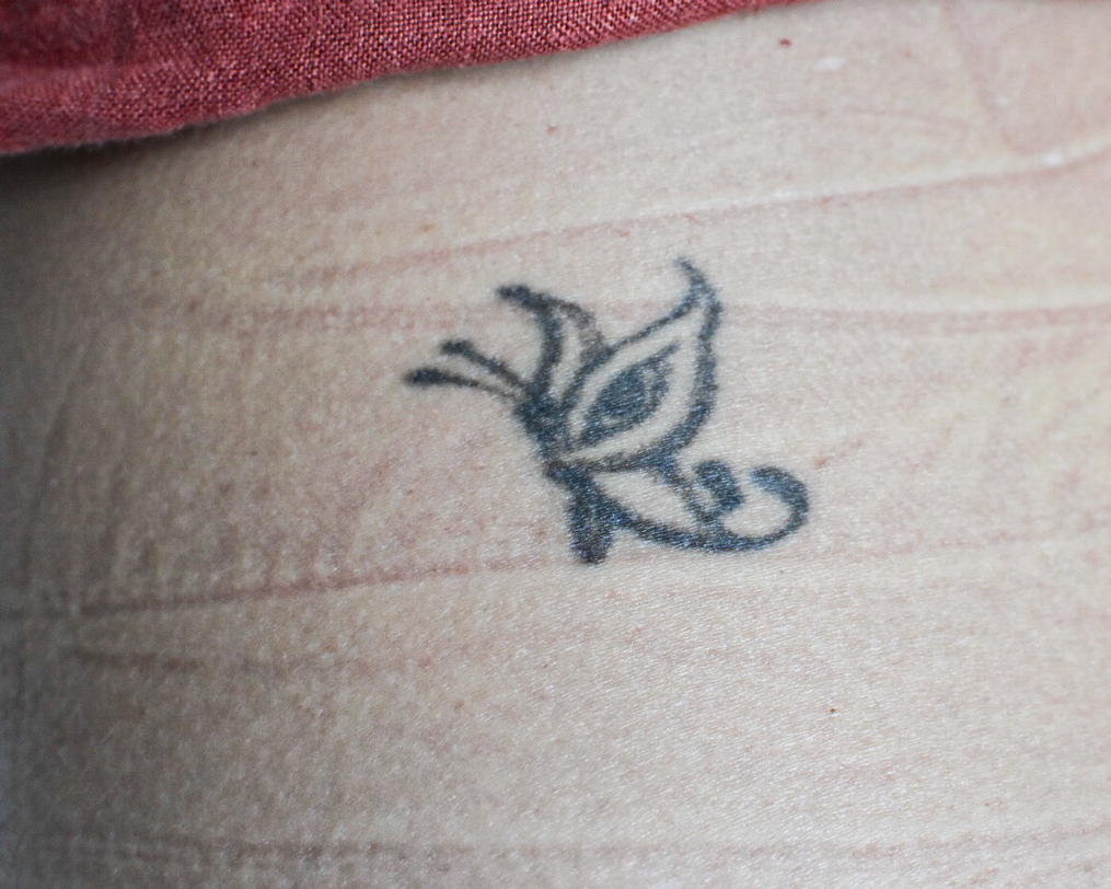 Tratamiento Eliminación de tatuajes