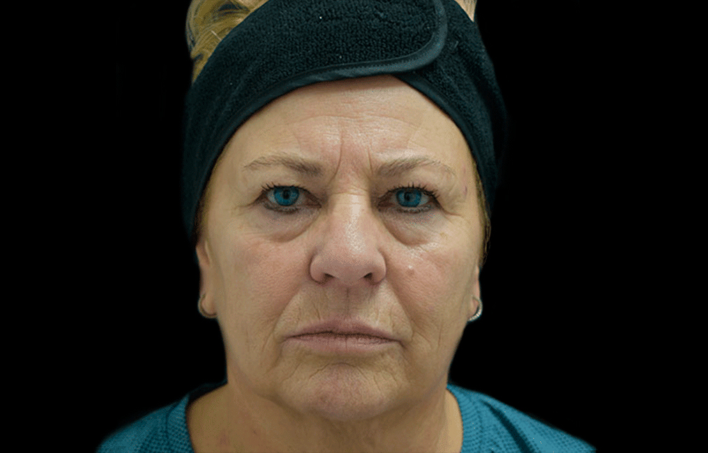 Tratamiento Teosyal Redensity