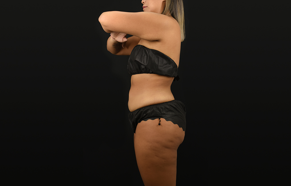 Tratamiento BTL X-Wave