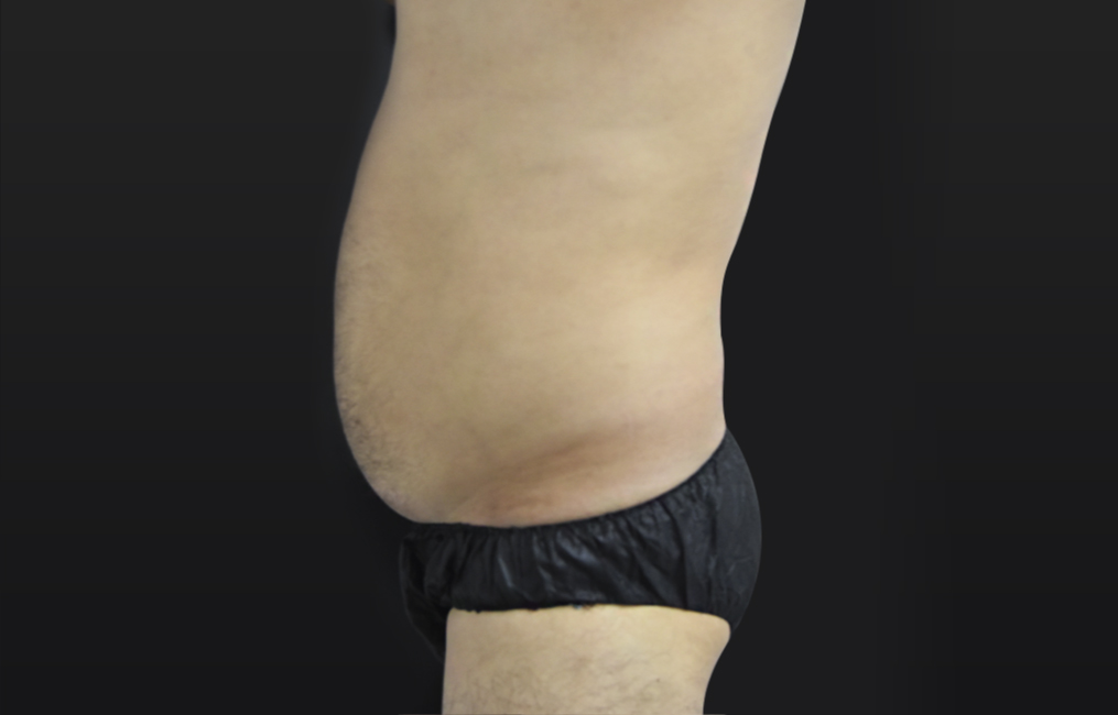 Tratamiento BTL X-Wave