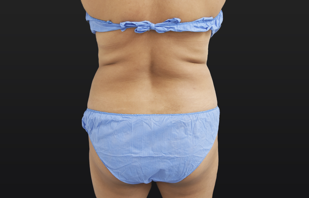 Tratamiento BTL X-Wave